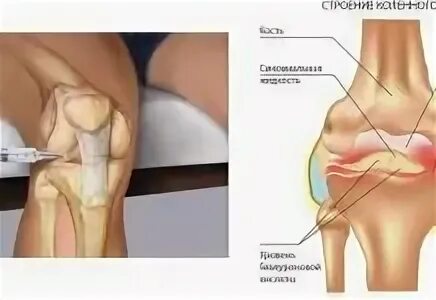 Гиалуроновой в тазобедренном суставе. Введение гиалуроновой кислоты в тазобедренный сустав. внутрисуставные инъекции в коленный сустав. внутрисуставное введение в тазобедренный сустав. внутрисуставные инъекции в тазобедренный сустав.