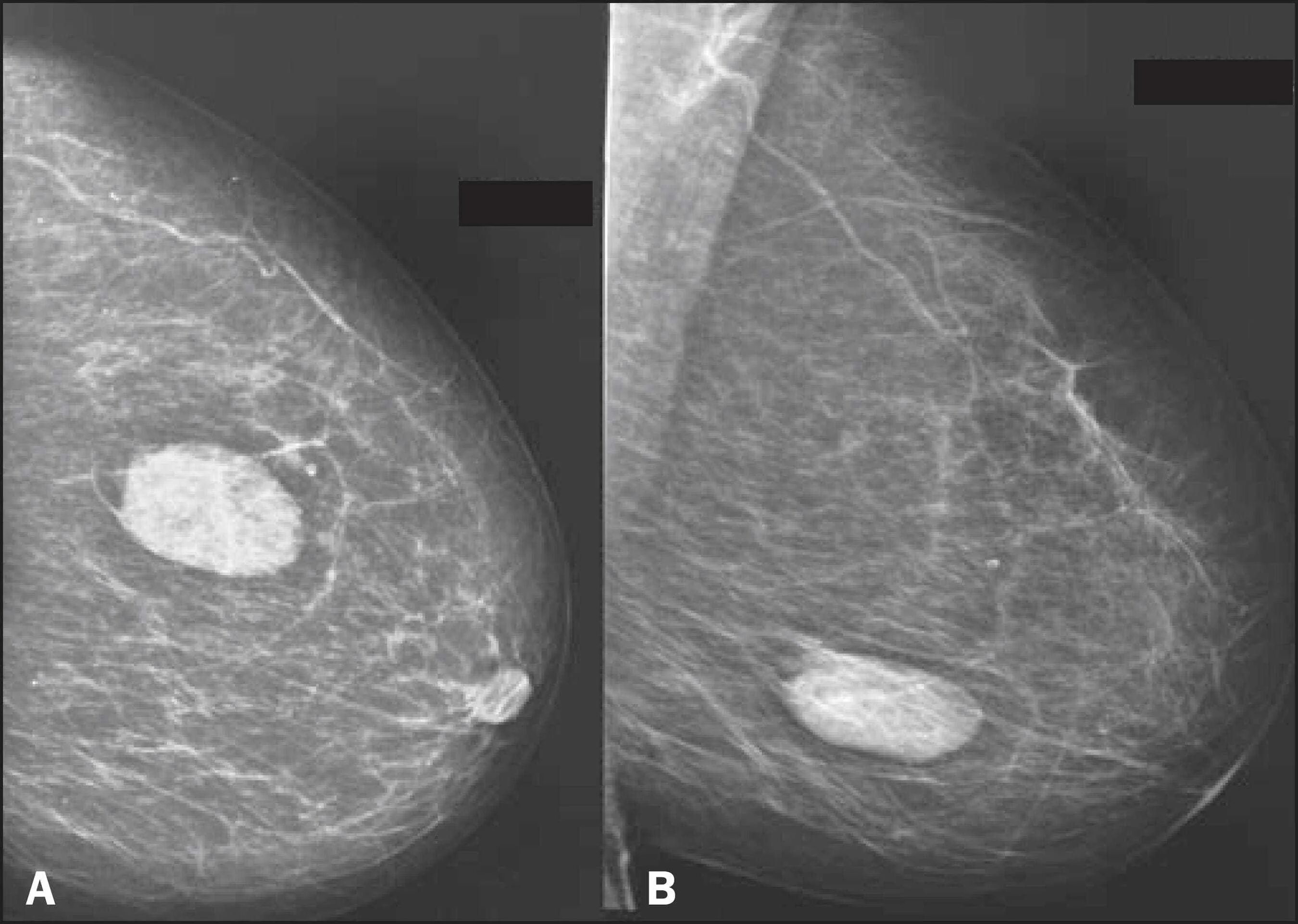 Диффузно фиброзная мастопатия bi rads 2. Фиброаденома молочной железы маммография. Маммография фиброаденома. Филлоидная фиброаденома. Маммография молочных желез фиброаденома.