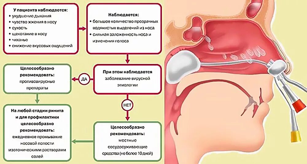 Вазомоторный аллергический ринит. Острый и хронический насморк. Острый вазомоторный ринит. Отеки после орви