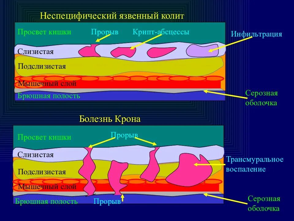 Воспаление серозной оболочки. Воспалительные заболевания кишечника этиология. Неспецифический язвенный колит. Патогенез язвенного колита. Патогенез язвенного колита и болезни крона.