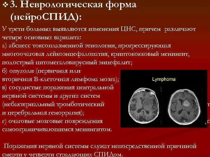 Образец вич. Формы СПИДА. Клинические формы СПИДА. Церебральная форма СПИДА.