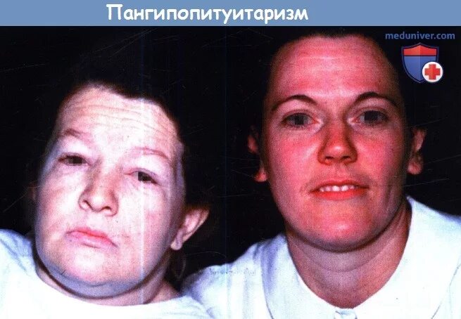 Гормональные лекарства побочные действия. Гормональная терапия. Последствия после гормональных. Последствия после гормональных. Лицо после гормонального крема.