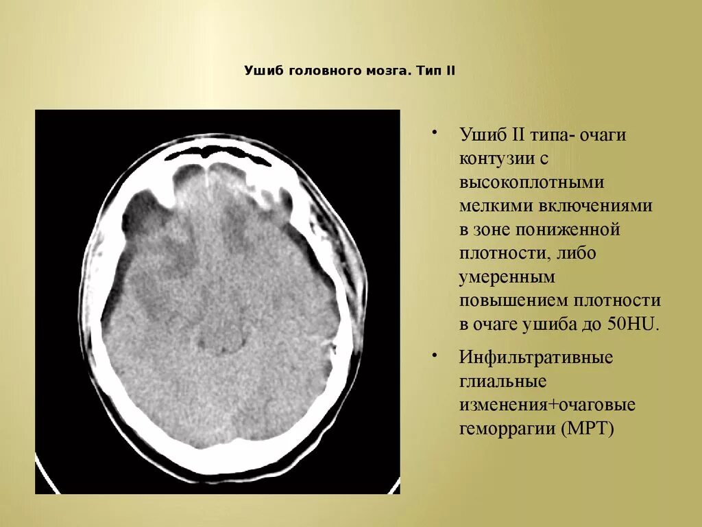 Что значит очаг в головном мозге. Контузионные очаги головного мозга 2 типа. Ушиб головного мозга 2 типа на кт. Ушиб головного мозга 1 типа кт. Контузионный очаг в головном мозге.