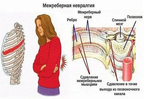 Меж ребер невралгия симптомы