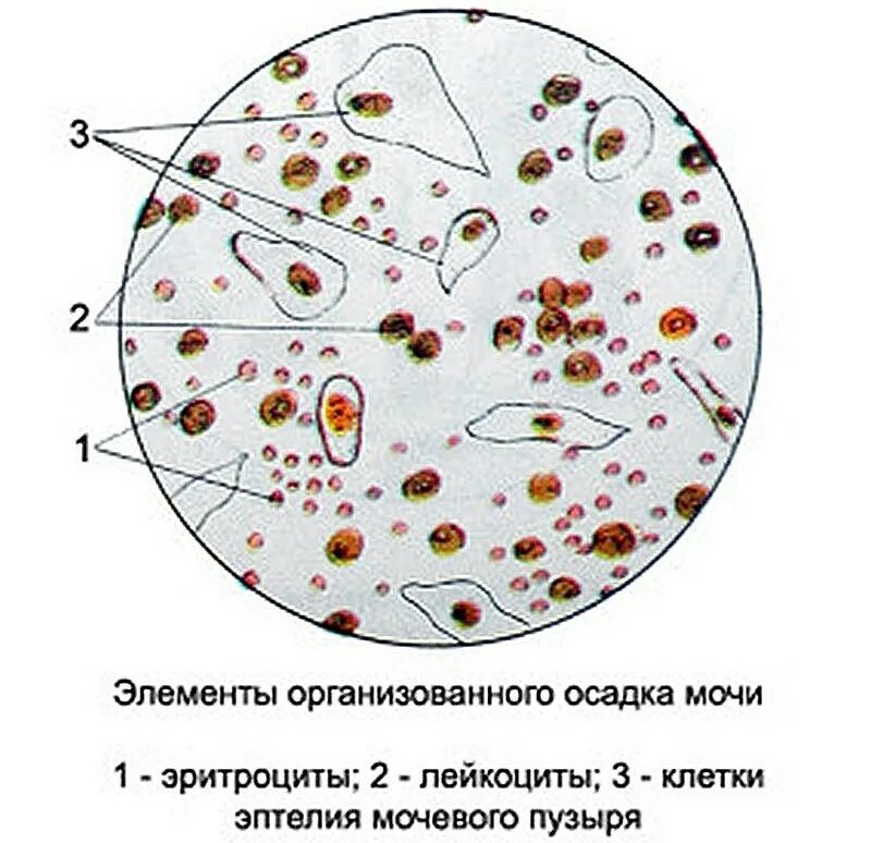 Лейкоциты при микроскопия мочи. Микроскопия организованного осадка мочи. Нечипоренко микроскопия. Микроскопия мочи лейкоциты и эритроциты.