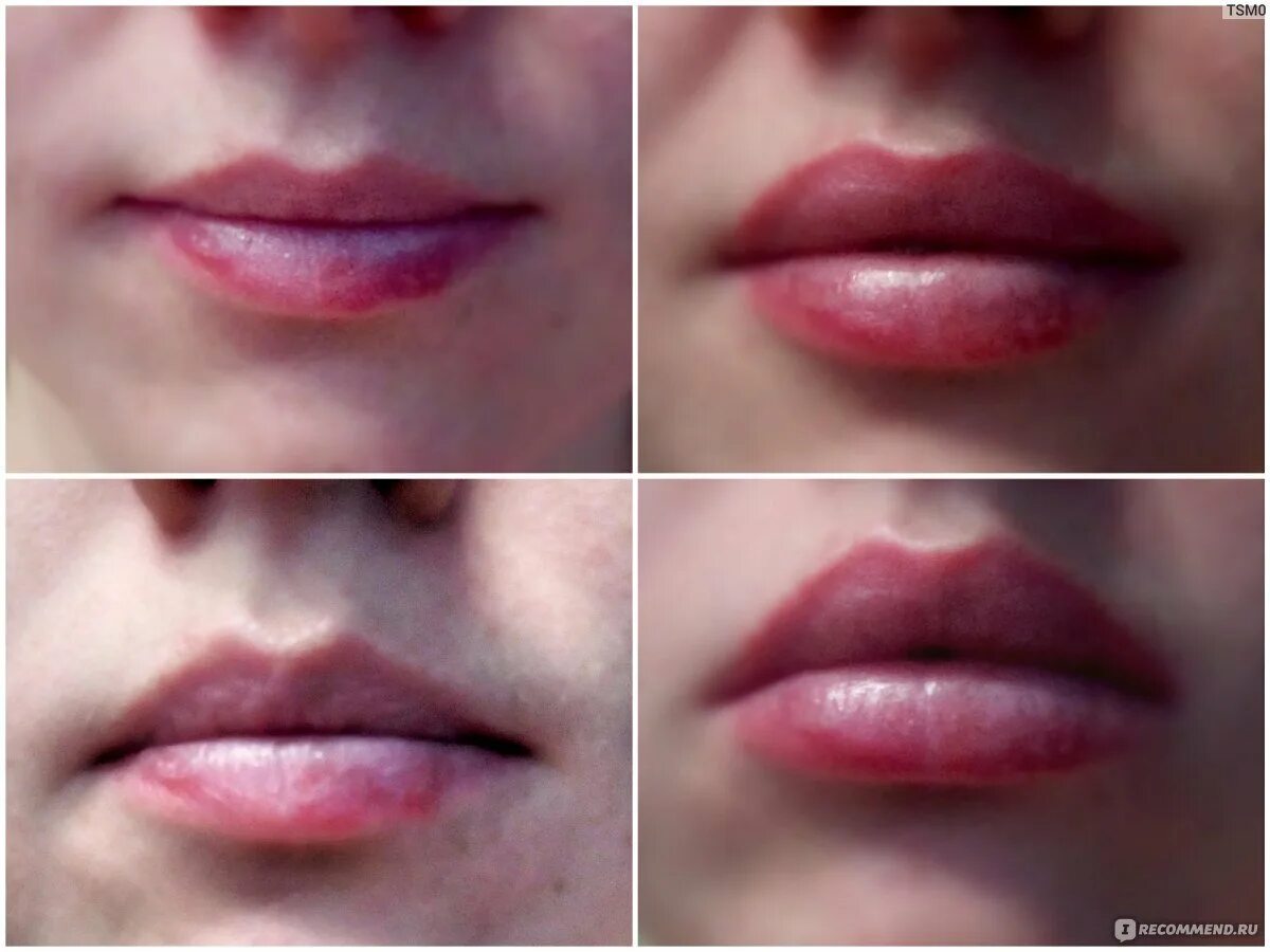 Коррекция формы губ филлером. Увеличение губ кемерово. Простуда на губе и увеличение губ. А ты записалась на контурную пластику губ. Увеличение губ кемерово.