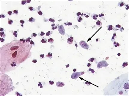 Gardnerella vaginalis причины возникновения