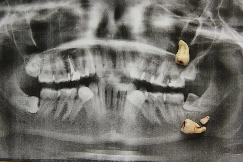 Лежащие зубы. Ретинированный зуб мудрости рентген. Ретинированный дистопированный зуб. Ретинированный зуб рентген. Лежащие зубы.