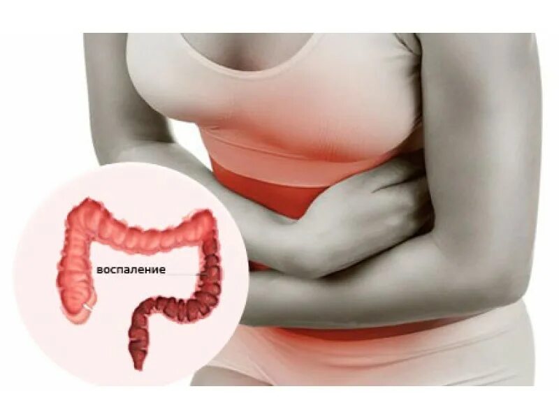 Симптомы хронического колита у женщин. Воспаление кишечника колит. Энтерит колит энтероколит. Гастроэнтероколит клиническая картина. Симптомы кишечника колит кишечника.