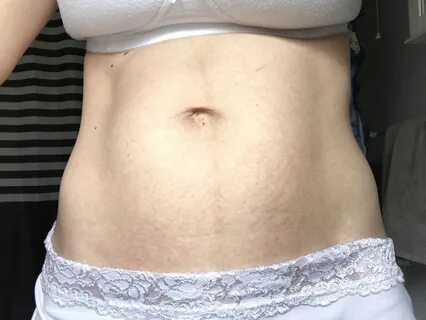 Read Clinically proven stretch mark white stretch marks: The difference Pre...
