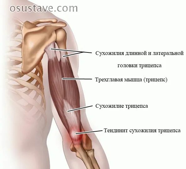 Почему болят локтевые сгибы. Тендинит сухожилия трицепса локтевого сустава. Тендинит трехглавой мышцы локтевого сустава. Тендовагинит сухожилия двуглавой мышцы. Кальцинирующий тендинит сухожилия трицепса.