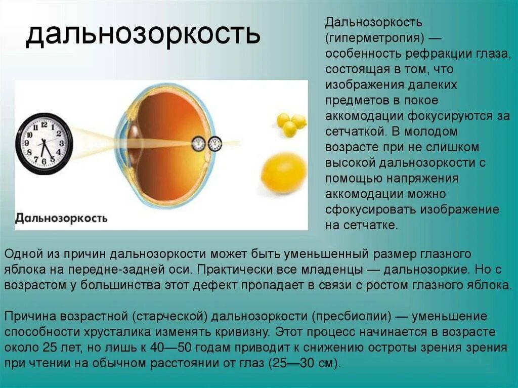 Сообщение на тему дальнозоркость. Миопия дальнозоркость астигматизм. дальнозоркость (гиперметропия). близорукость и дальнозоркость глазное яблоко. зрение при близорукости.