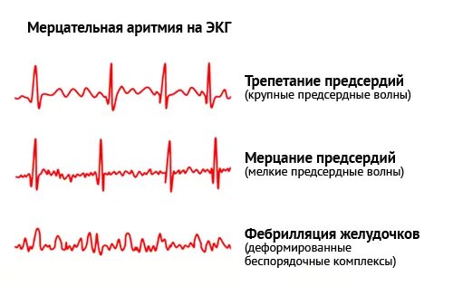 Что покажет аритмию сердца