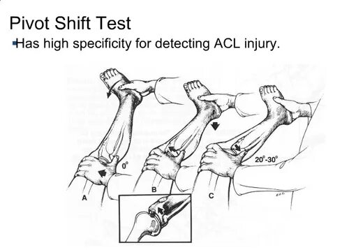 Тест Pivot Shift коленного сустава. Тесты на разрыв передней крестообразной связки. Тесты на коленный сустав