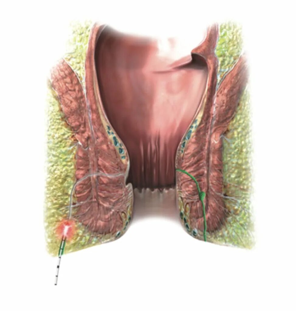 В заднем проходе шарик у женщин что. Хронический парапроктит. Интрасфинктерный парапроктит.