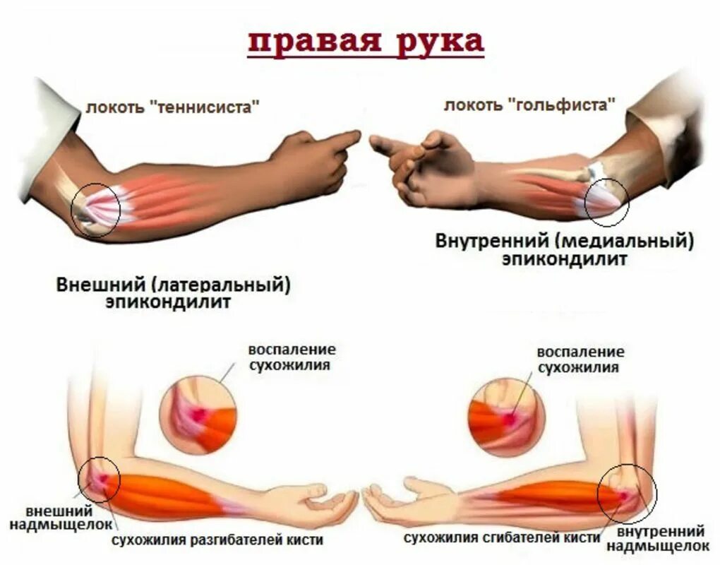 Болит рука после нагрузки