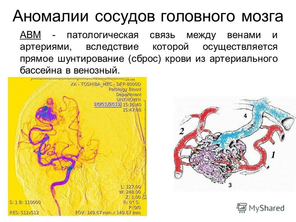 Сосудистая аномалия. Аномалии артерий головного мозга. Бассейны сосудов головного мозга.