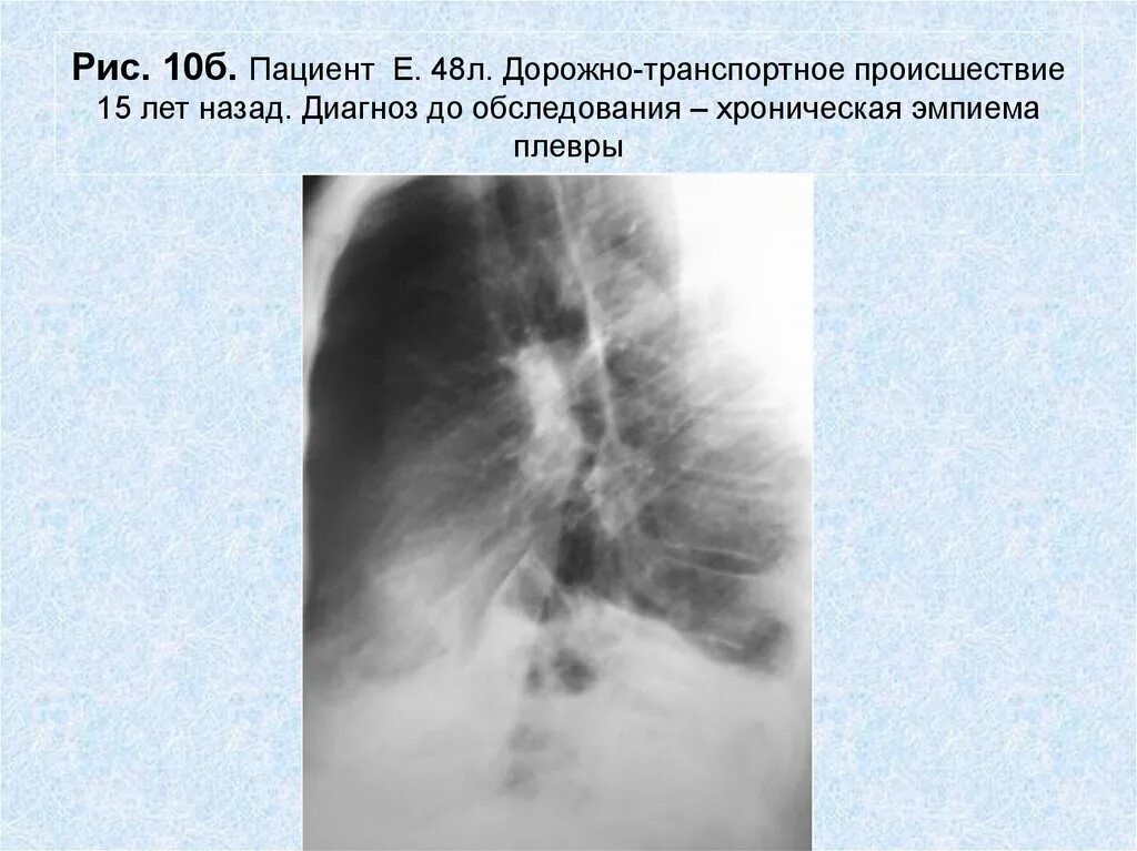 Эмпиема легкого. Эмпиема легкого рентген. Пневмония и эмпиема плевры. Эмпиема легкого клиника. Хроническая эмпиема плевры ангиопульмонография.