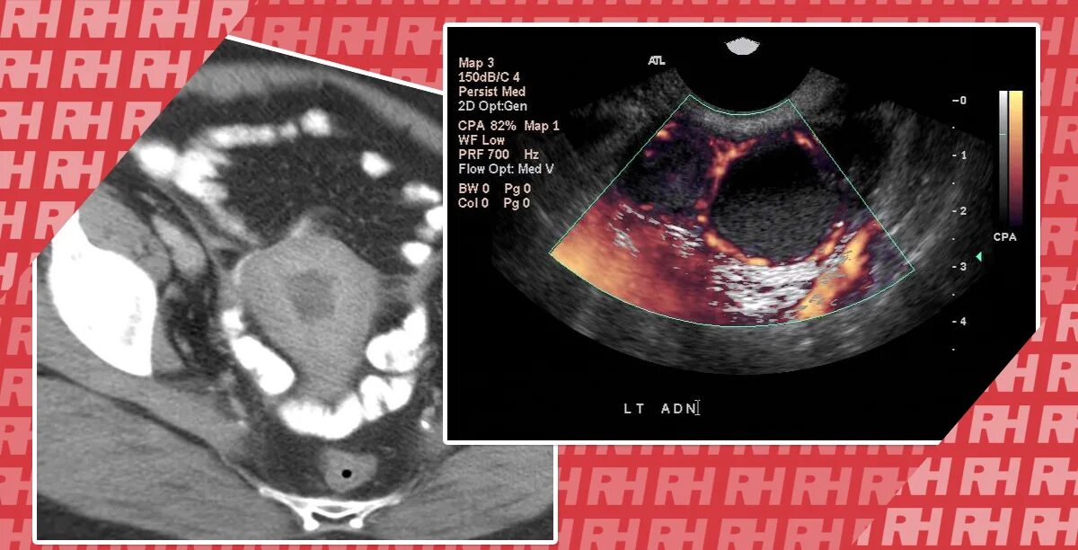 Снимок непроходимости маточных труб. Яичники у новорожденного на узи протокол. Трубы маточные визуализируются на узи. Трубы не визуализируются. Трубы не визуализируются.