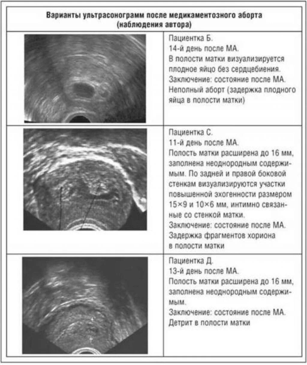 Через сколько месячные после медикаментозного прерывания. Неполный маточный аборт. Остатков плодного яйца в полости матки. Неполный медикаментозный аборт на УЗИ. Остатки в матке после медикаментозного аборта.