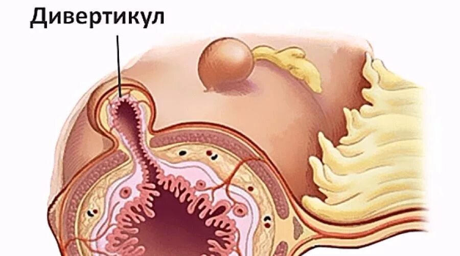 Дивертикулы толстой кишки колоноскопия. Дивертикулы ободочной кишки. Дивертикулез сигмовидной кишки. Дивертикул осложнения