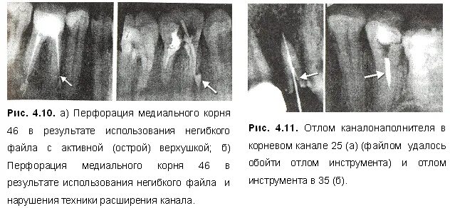 Ошибки при пломбировании корневого канала. Ошибки пломбирования корневого канала. Отлом эндодонтического инструмента в канале корня. Осложнения пломбирования корневых каналов. Осложнения эндодонтического лечения