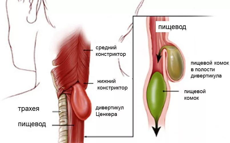 Локализация пищевода. Дивертикул Ценкера рентген. Дивертикулы пищевода, дивертикул Ценкера. Пульсионный дивертикул пищевода. Дивертикул Ценкера классификации.