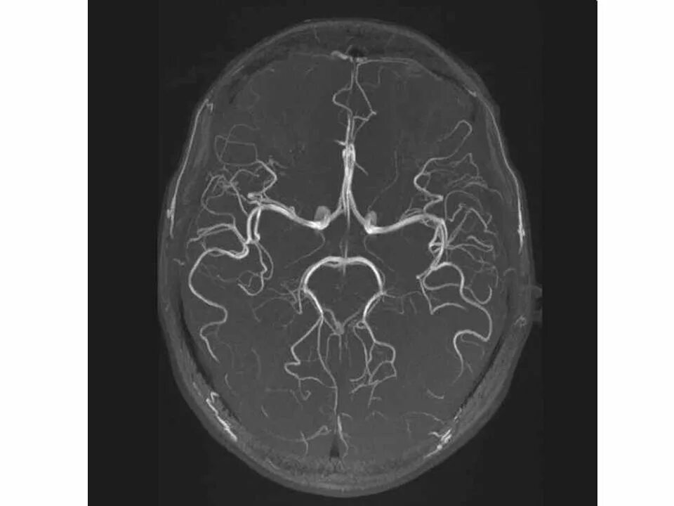 Виллизиев круг вариант развития на мрт. Магнитно-резонансная ангиография сосудов головного мозга. Мрт ангиография сосудов головного мозга. Кт ангиография церебральных сосудов головного мозга. Кт ангиография аневризма головного мозга.