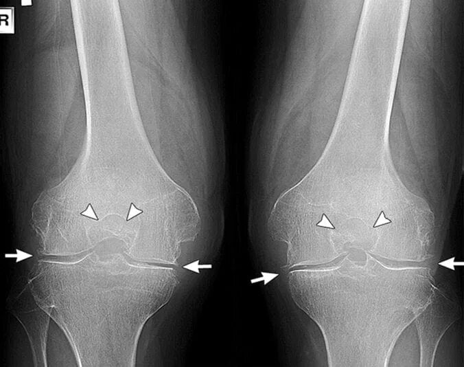 Суставная щель не сужена. Суставная щель не сужена. Строение локтевого сустава рентген. Коксартроз 2 степени рентген. Асептический некроз коленного сустава рентген.