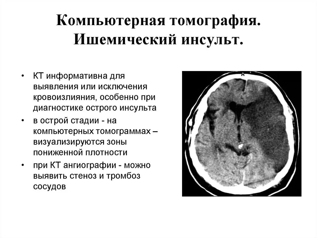 Протокол кт головного мозга ишемический инсульт. Ишемический инсульт на кт головного мозга. При ишемическом инсульте на кт визуализируются. Ишемический и геморрагический инсульт на кт. Постишемические изменения мозга