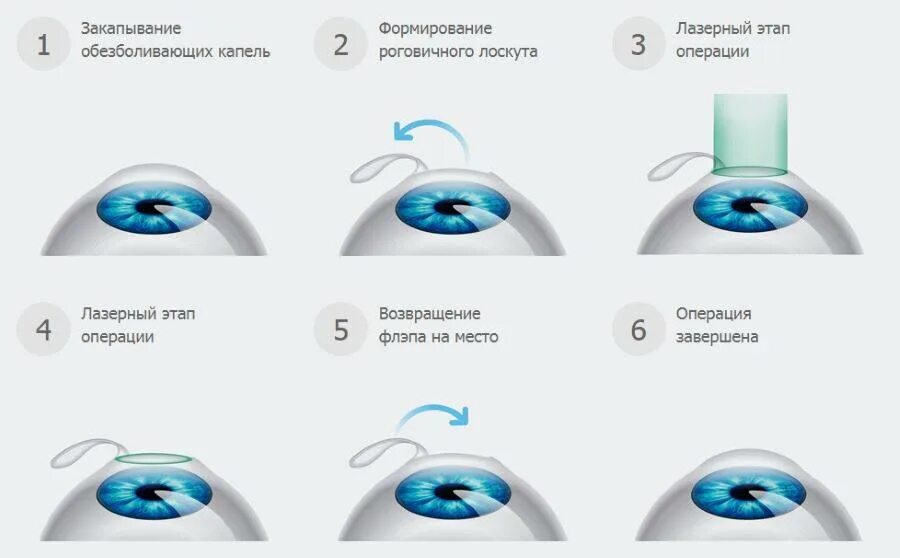 Коррекция зрения клиника спектр clinicaspectr ru. Ласик схема операции. Лазерная коррекция зрения ласик ФРК. Этапы лазерной коррекции зрения ласик. Лазерная коррекция зрения Femto ласик.