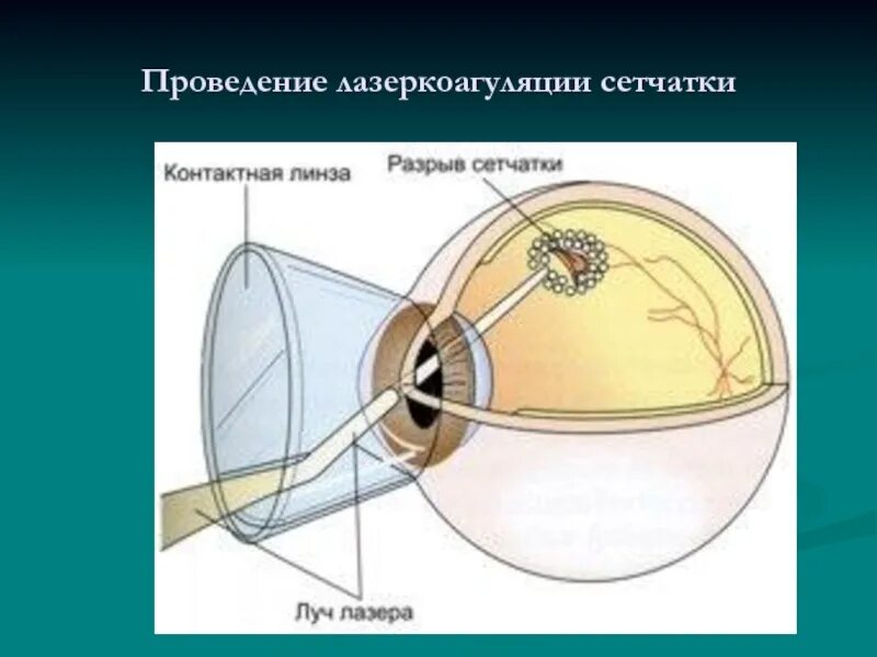 Ограничительная лазеркоагуляция сетчатки глаза. Линза для лазерной коагуляции сетчатки. Периферическая лазеркоагуляция сетчатки глаза. Приваривание лазером отслоившейся сетчатки глаза.