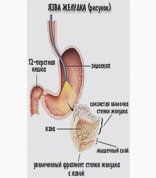 Молочница жкт. Кандидоз пищевода эндоскопия. Схема лечения кандидоза кишечника. Молочница жкт. Кандидоз кишечника лекарство.