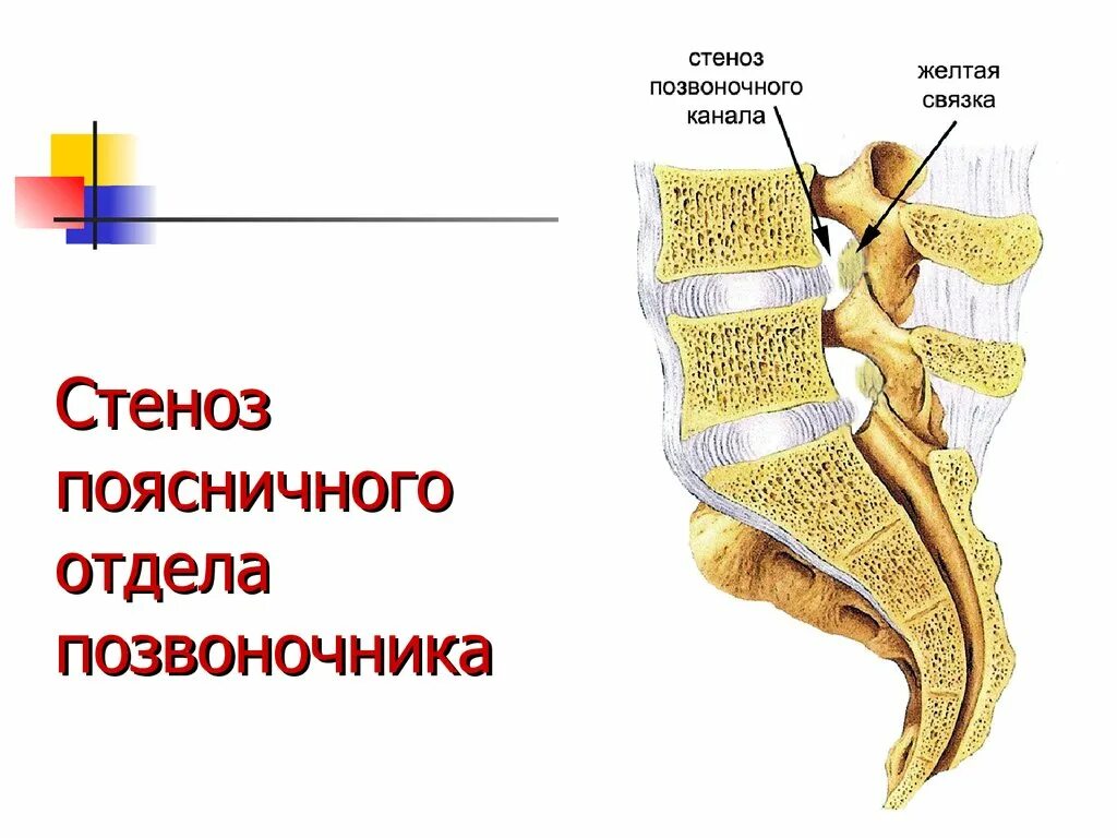 Поясничный абсолютный стеноз