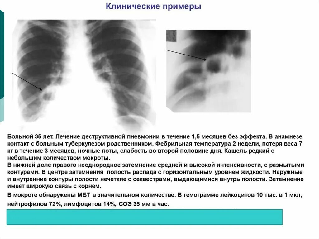 Пневмония в правой нижней доле. Фиброзно-кавернозный туберкулез кт. Лобит инфильтративный туберкулез. Инфильтративная пневмония. Туберкулез нижней доли правого легкого.