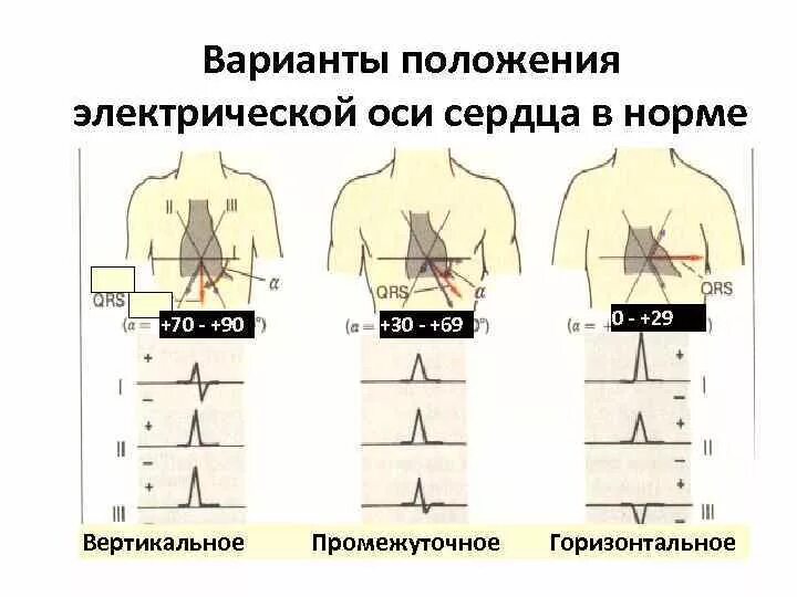 Вертикальная позиция сердца. ЭКГ вертикальное положение электрической оси. Положение оси на ЭКГ. Вертикальное и горизонтальное положение ЭОС на ЭКГ. Вертикальная ось сердца на ЭКГ.