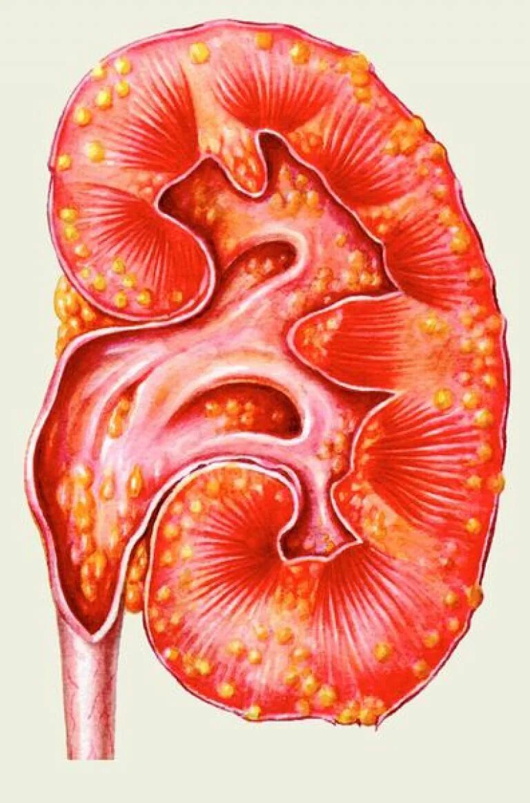 Почечная болезнь пиелонефрит. Острый апостематозный пиелонефрит. Острый нефрит пиелонефрит. Пиелонефрит почек макропрепарат. Хронический пиелонефрит поражение почек.