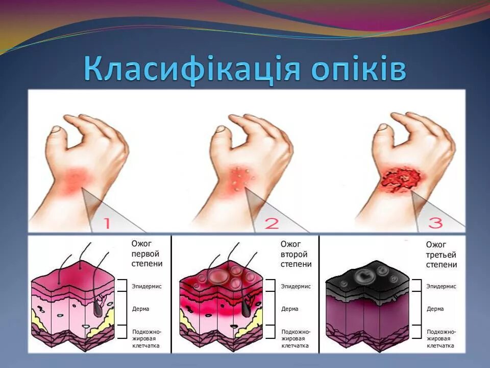 Сколько заживает ожог 2