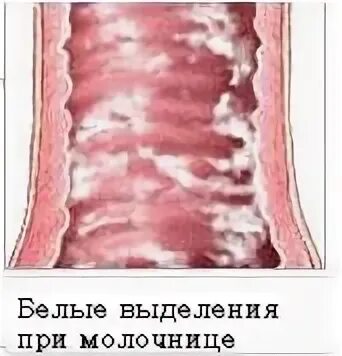 Плохие выделения у девушки - фотоподборка