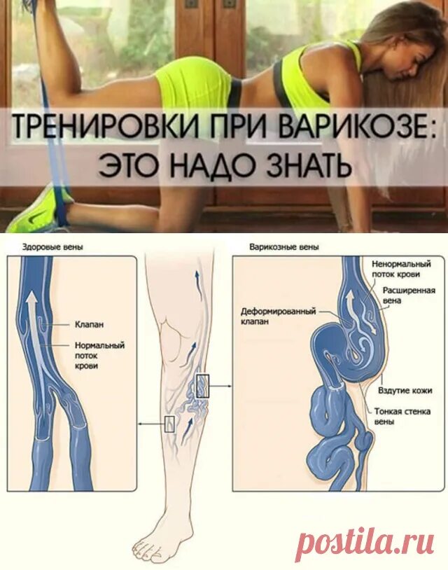 Тренировки при варикозе. Упражнения от варикоза. упражнения от варикозного расширения. фитнес упражнения при варикозе.