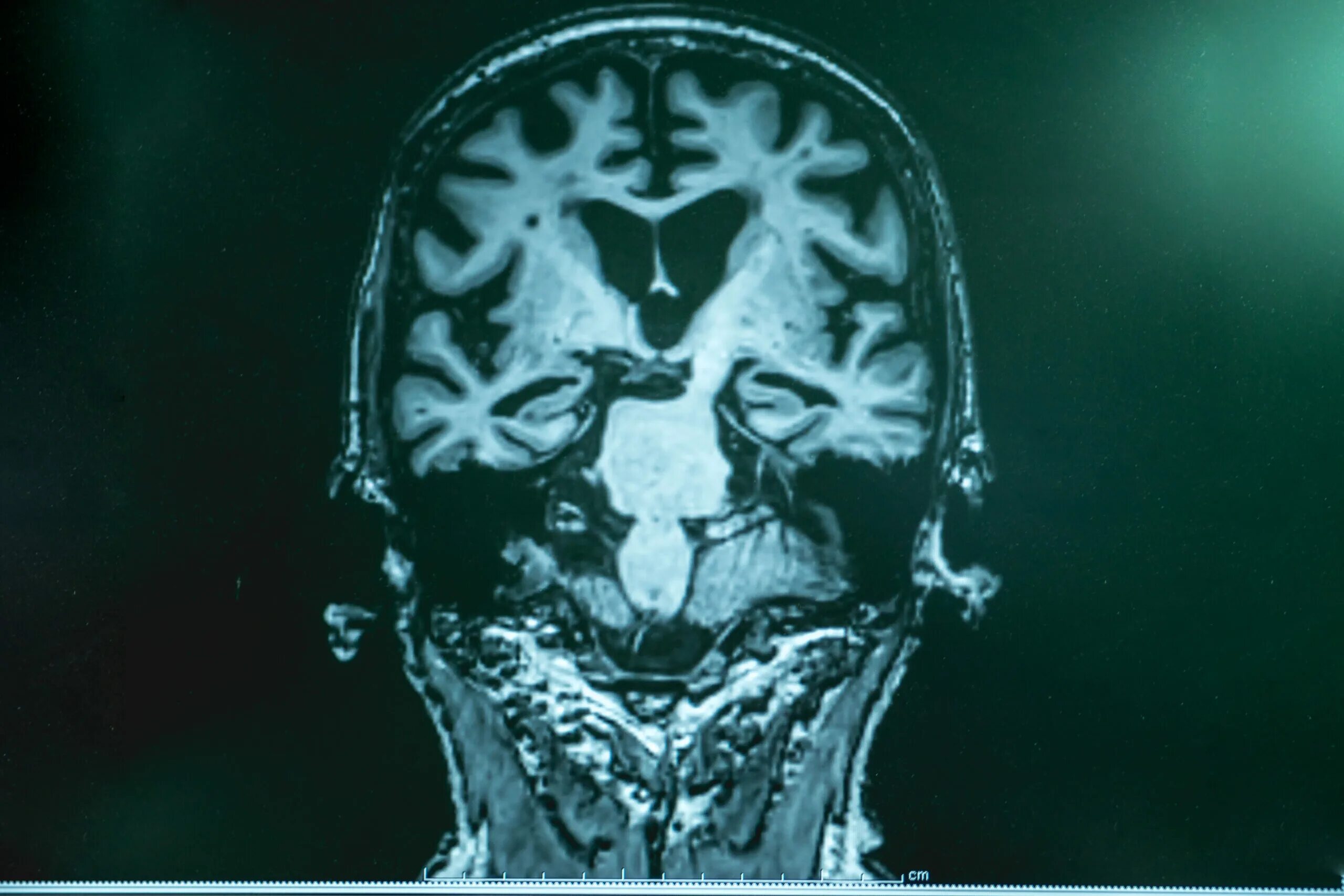 Болезнь Альцгеймера снимок мозга. Болезнь Альцгеймера мрт. Снимок мозга при болезни Альцгеймера. Мрт снимок с болезнью Альцгеймера. Brain disease