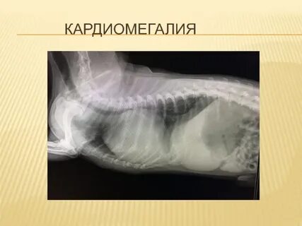 Кардиомегалия