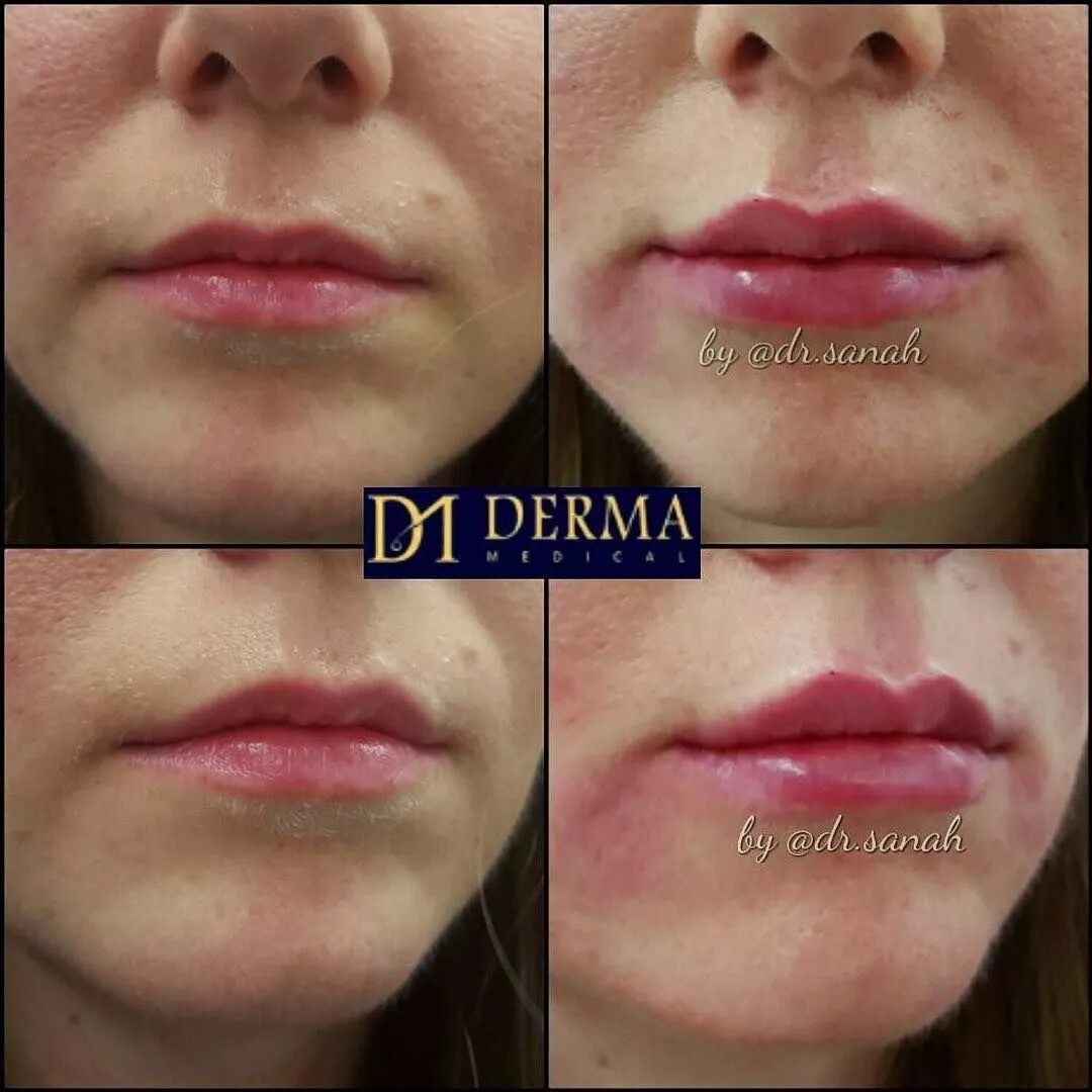 Губы после ювидерм. Juvederm Volift 1 мл. Ювидерм филлер 0.5 мл в губах.