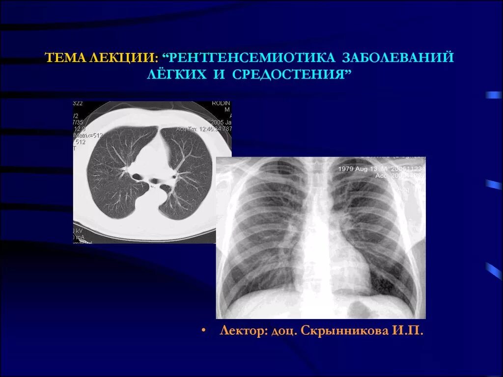 1 поражения легких. Лучевая семиотика заболеваний средостения. Объемные образования средостения рентгенодиагностика. Рентгенологическая семиотика заболеваний легких. Патология средостения легких.