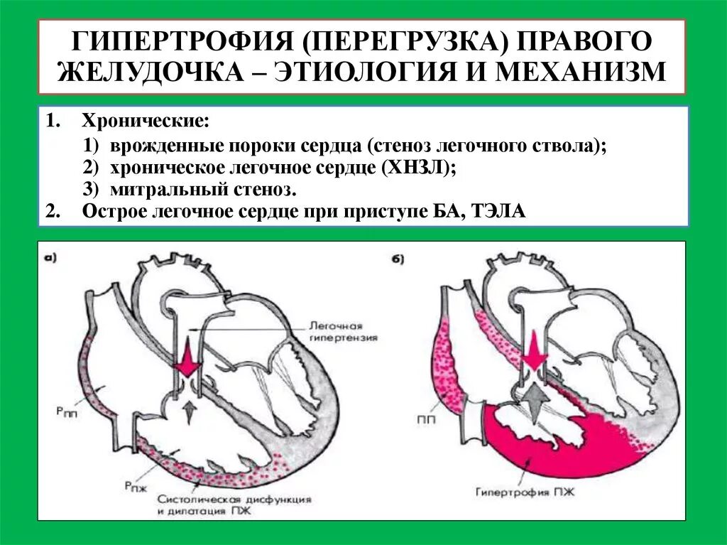 Гипертрофия желудочка аускультация. Причины гипертрофии миокарда правого желудочка. ЭКГ синдром гипертрофия миокарда отделов сердца механизмы. Причины гипертрофии левого и правого желудочков сердца. Гипертрофия левого предсердия левого желудочка