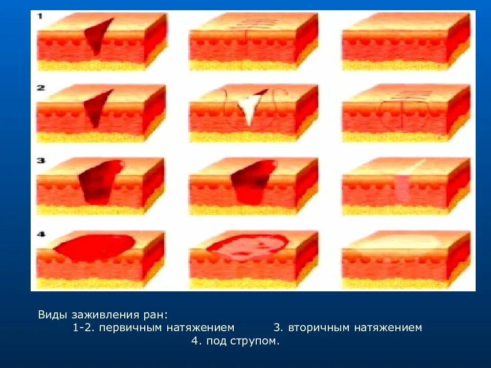 Стадии заживления послеоперационных РАН. Заживление РАН после операции геморроидэктомии.