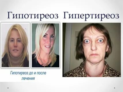 Гипотиреоз токсический зоб