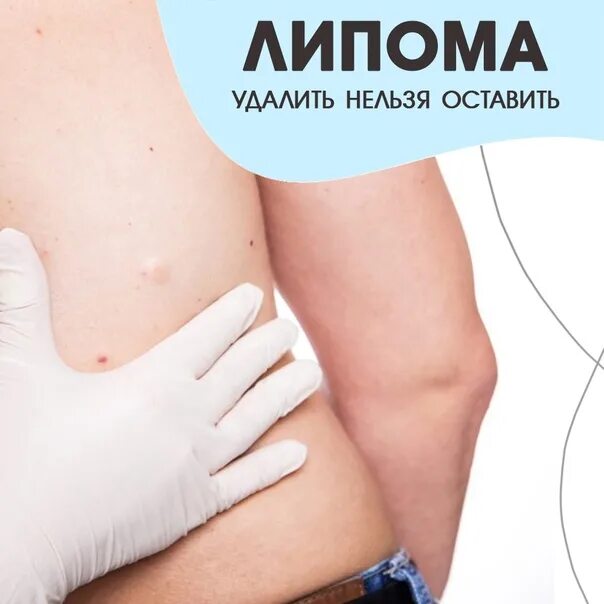 Удаление липомы новосибирск. Липома жировик подкожный. Удаление липомы новосибирск. Удаление липомы новосибирск. Удаление жировика на спине.