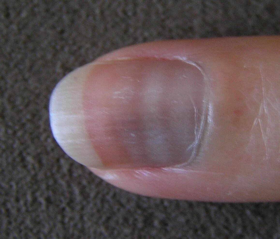 Горизонтальные полосы на ногтях