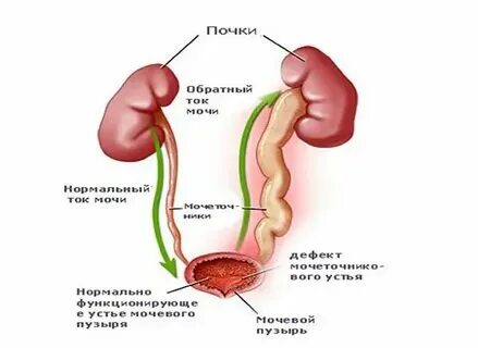 Нефроптоз 3 степени. Почккамни в мочеточнике. Мочеточник анатомия у женщин. Мочеточники человека. Строение мочеточника.